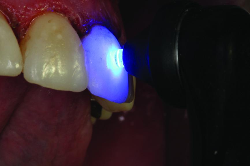 Klare Linse für punktförmige Aushärtung kleiner Kompositfüllungen oder „fixierende“ Befestigung von Veneers. (Foto: Ultradent Products)