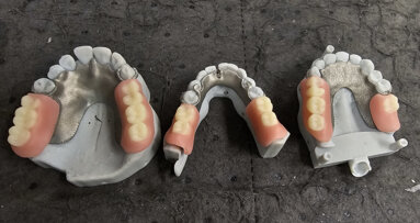 From weeks to days: Dental laboratory halves production time for removable partial dentures