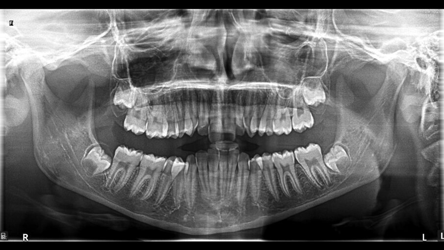 Fig. 11_Ortopantomografia pre-trattamento.