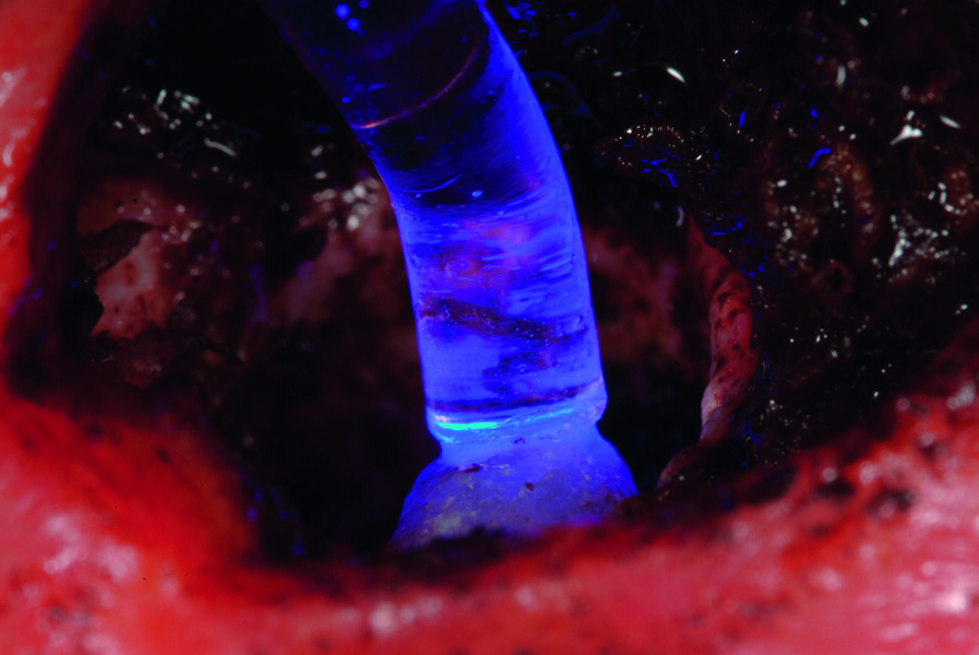 EndoGuide Lens_apikale retrograde Fuellungen