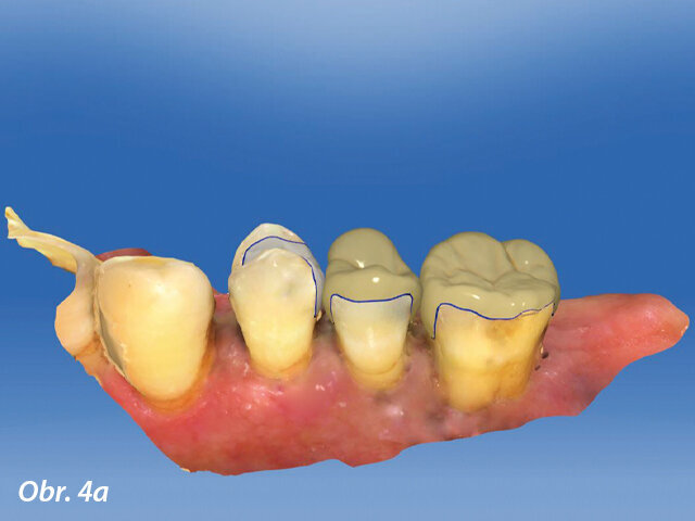Ilustrační snímek z CAD výroby v distálním úseku horní čelisti.
