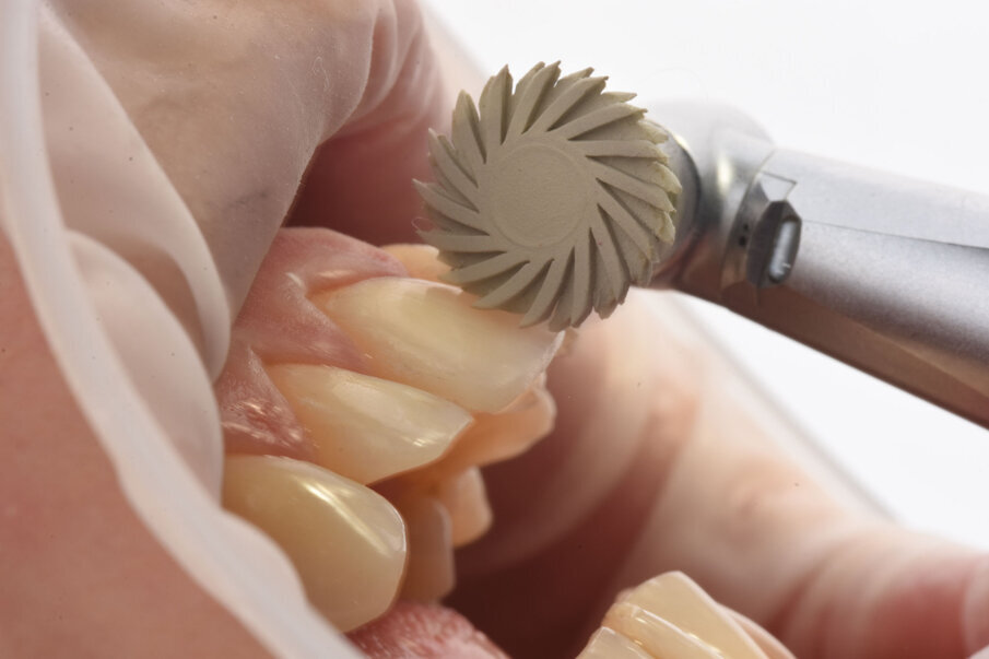 Sl. 17: Završna obrada i poliranje restauracije