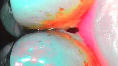 Wykorzystanie fluorescencji i selektywnego chromatycznego wzmocnienia w codziennej profilaktyce stomatologicznej