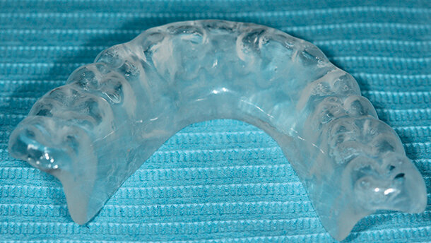 Attualità clinica  della semeiotica occluso-posturale: protocollo diagnostico e caso clinico