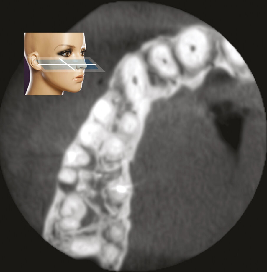 Fig. 1h - La sezione assiale mostra le lesioni del primo e del secondo molare, interessanti queste ultime per l’aspetto palatino delle due radici. È ovvio il motivo per cui tali lesioni non erano apprezzabili nella radiografia periapicale.