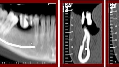 Cirugías complementarias para la modificación ósea de la mandíbula atrófica