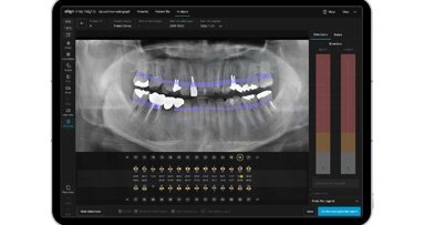 Align Technology lancia in Europa e Regno Unito Align X-ray Insights, un software di rilevamento computerizzato supportato dall’intelligenza artificiale