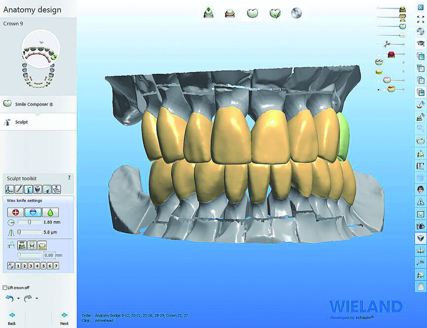 Fig. 9: Virtual plan of Zenostar restorations.