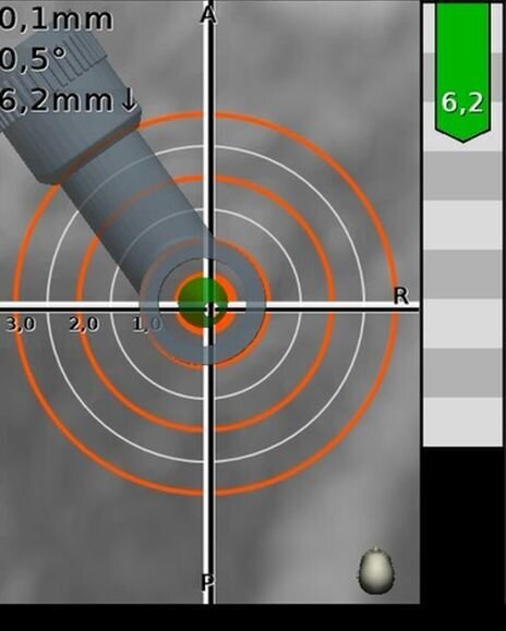Fig. 11 - Il “Mirino” del Navident. Con l’allontanarsi dall’approccio corretto l’indicatore da verde diviene prima giallo e poi rosso; analogamente nell’avvicinarsi alla profondità di fresaggio prevista il sistema ancora cambia in giallo (indicando anche la distanza che rimane alla fine del fresaggio) e quindi rosso quando la si supera; L’andamento chirurgico in corso di intervento.