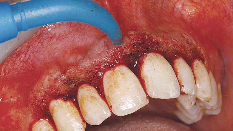 Estetika parodontu s využitím laserů na měkké tkáně