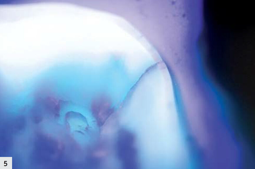 Figs. 4–5 : On peut observer une fissure très fine dont l’aspect est légèrement sombre ; aucune activité bactérienne n’est visible. 