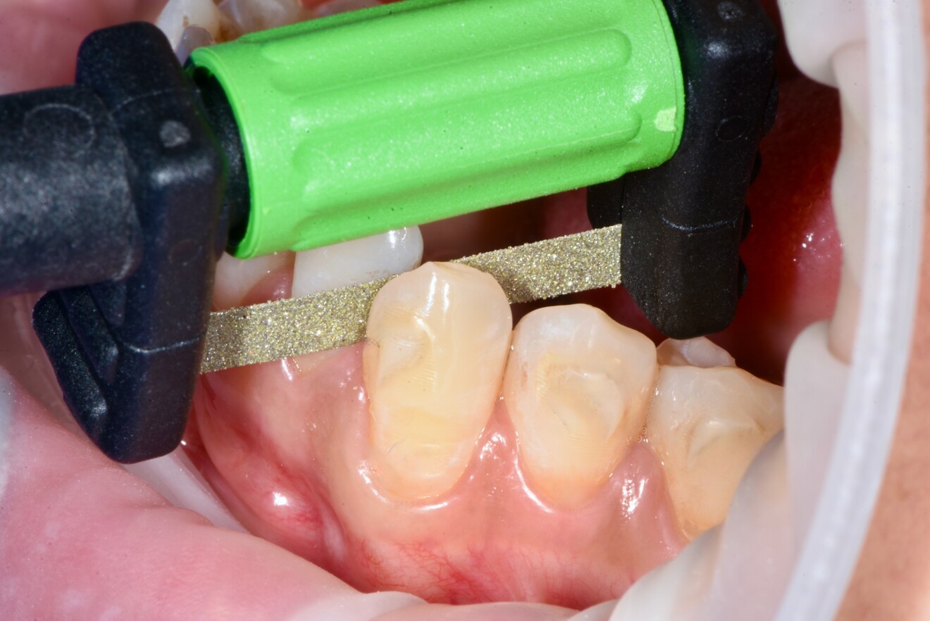 Fig 8 - Utilizzo di FitStrip per l’IPR.