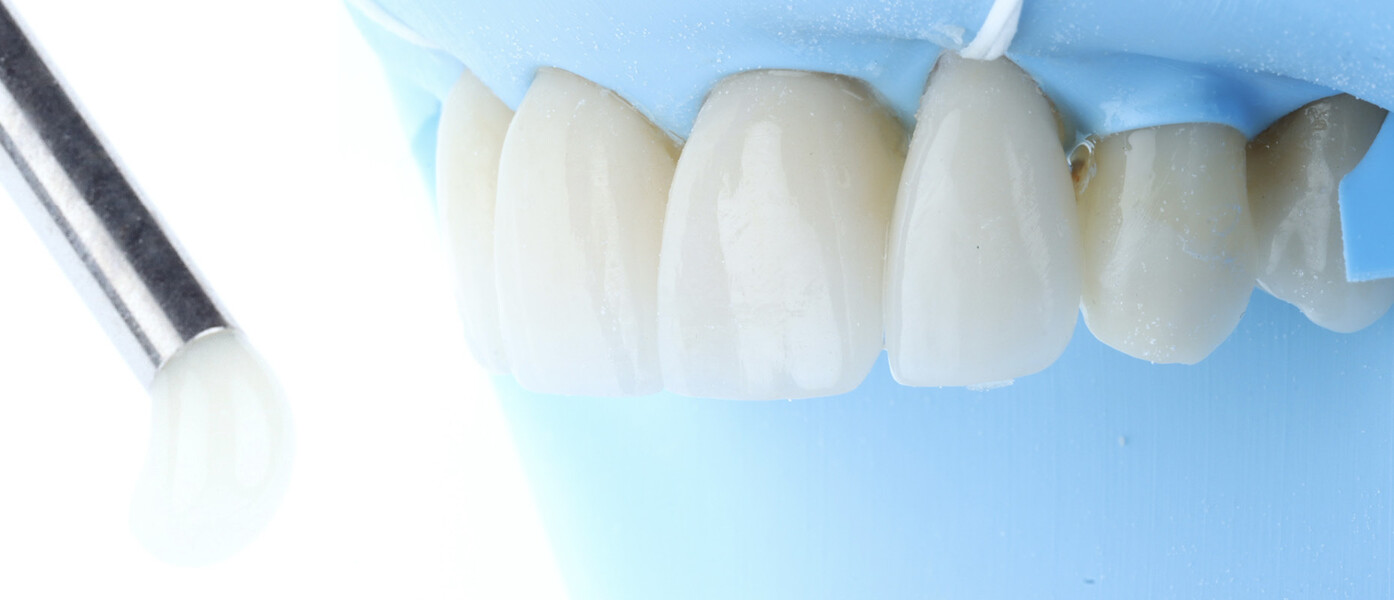 Fig. 21b: All four ceramic veneers in place after cementation. 