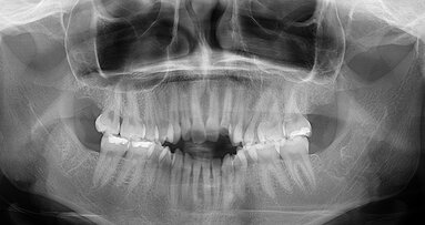 Intraorální skenery