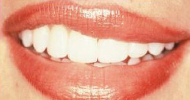 STA: essential for cosmetic dentistry