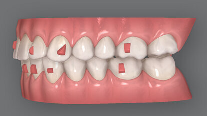 Důležitost plánování léčby a spolupráce pacienta u ortodontické techniky fóliových aparátů