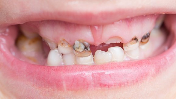 Quase 15 por cento das crianças norte-americanas com menos de 8 anos têm cárie dentária não tratada