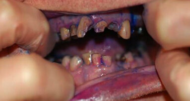 Dental hygiene for dependent adults