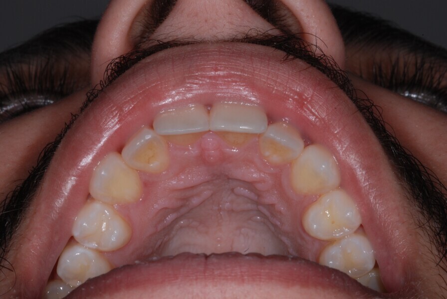 Fig. 32: Occlusal view after treatment.
