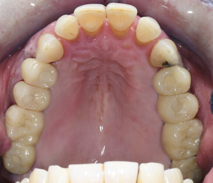 Fig. 10: Temporary restoration after six months of healing.