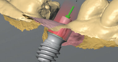 Náhrada zubu v jediné návštěvě: technika One-Tooth One-Time