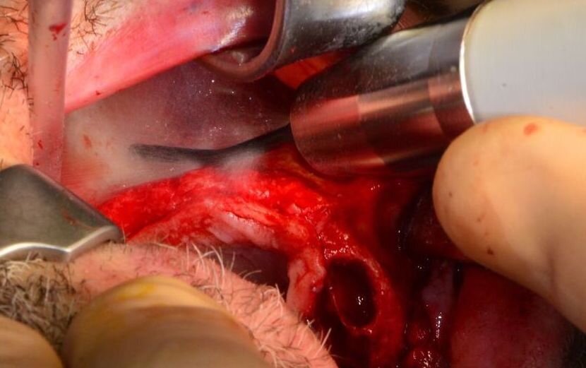 Fig. 4 - L’azione nebulizzante del piezoelettrico rende il campo operatorio estremamente visibile. 