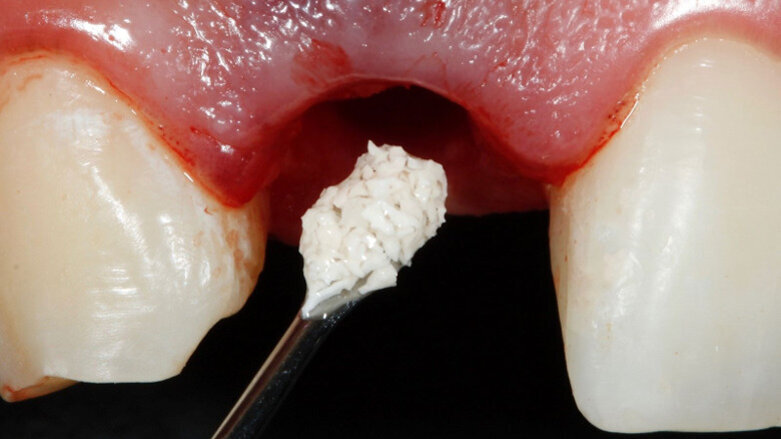 Four questions on Straumann biomaterials