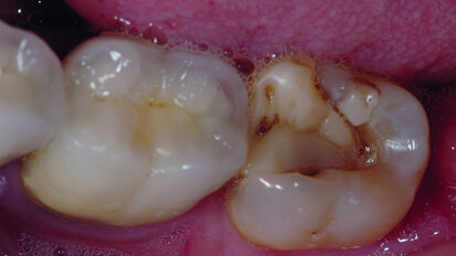 STOP aux sensibilités postopératoires sous les restaurations - séance interactive