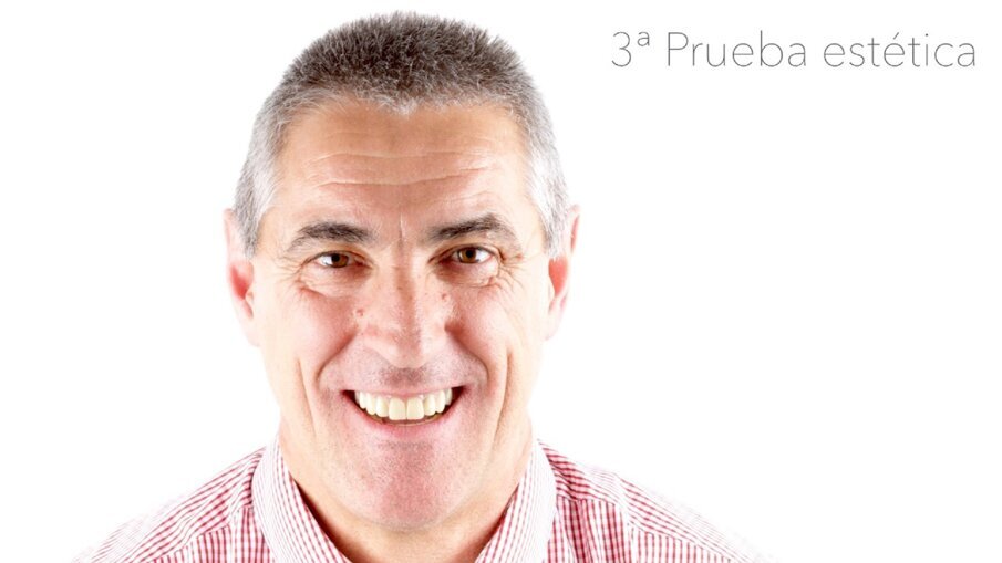 Fig. 4b: Evaluating the integration of the mock-up in the patient’s mouth.