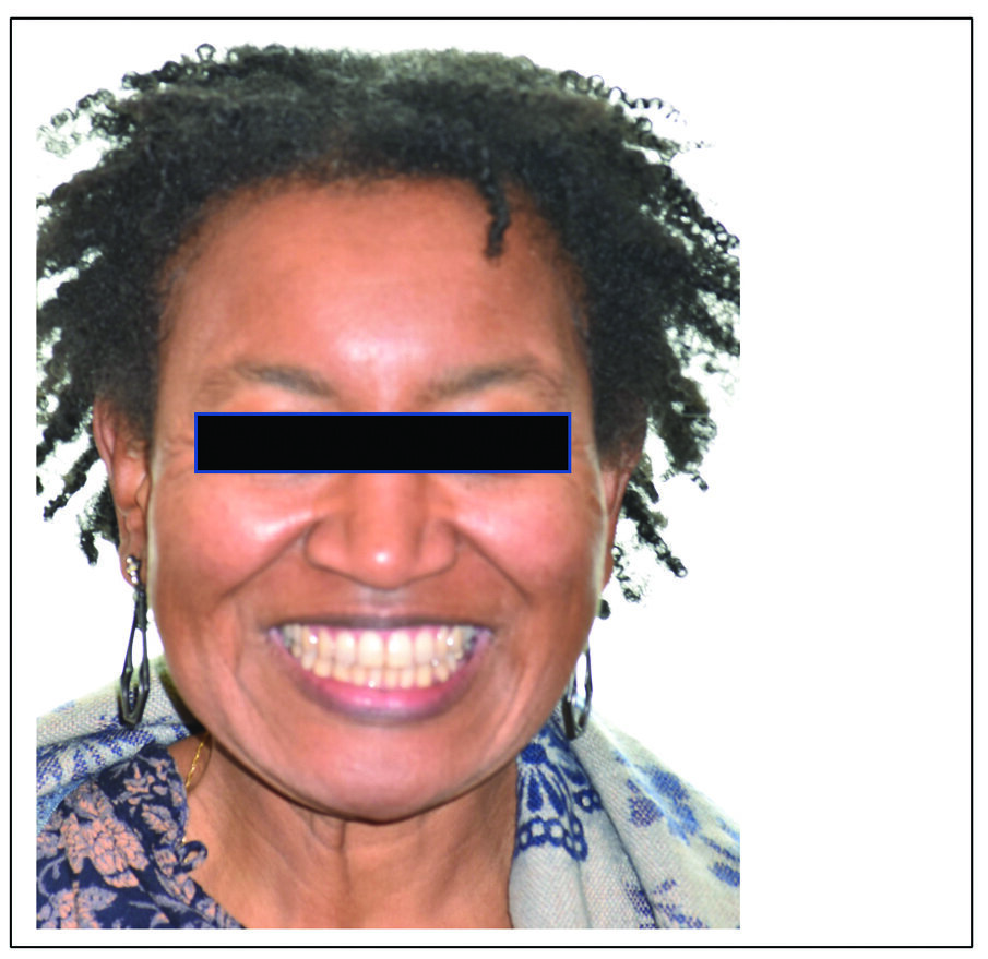 Fig. 13b. Patient S. P. post-treatment after 7.75 months and five appointments of treatment with Spark clear aligners. (Note: Actual patient images, which have not been altered. Patient results may vary.)