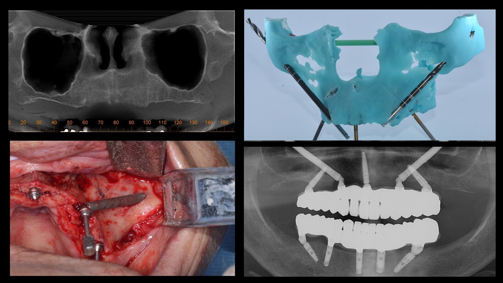 Rehabilitación del maxilar con implantes cigomáticos en paciente de edad avanzada