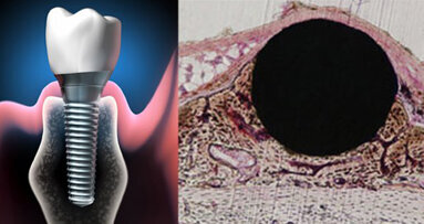 Forscher beschleunigen Osseointegration von Implantaten