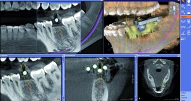 Pose chirurgicale d’implants guidée avec couronne CEREC fabriquée par CFAO