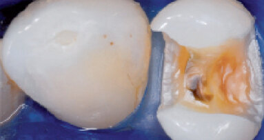 Klinické použití nového zatékavého podkladového materiálu pro přímé a nepřímé výplně