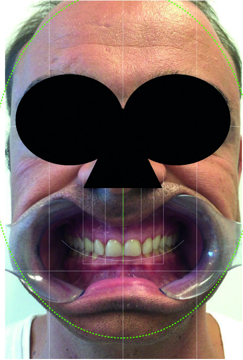 Fig. 5 : Protocole DSD : photographie du patient souriant, avec écarteur labial et jugal. 