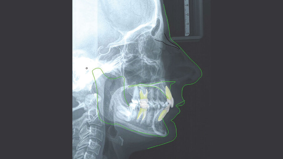 Figg. 3a-3c_Acquisizione dei records radiografici. Tracciato cefalometrico iniziale.