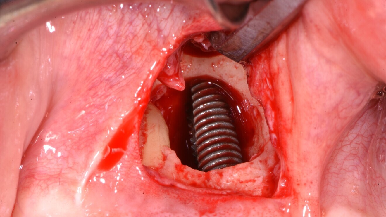 Fig. 7: View of the implant passing across the infra-bony cavity.