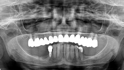 Restauro di una mandibola atrofica mediante impianti di 4,5 millimetri di lunghezza