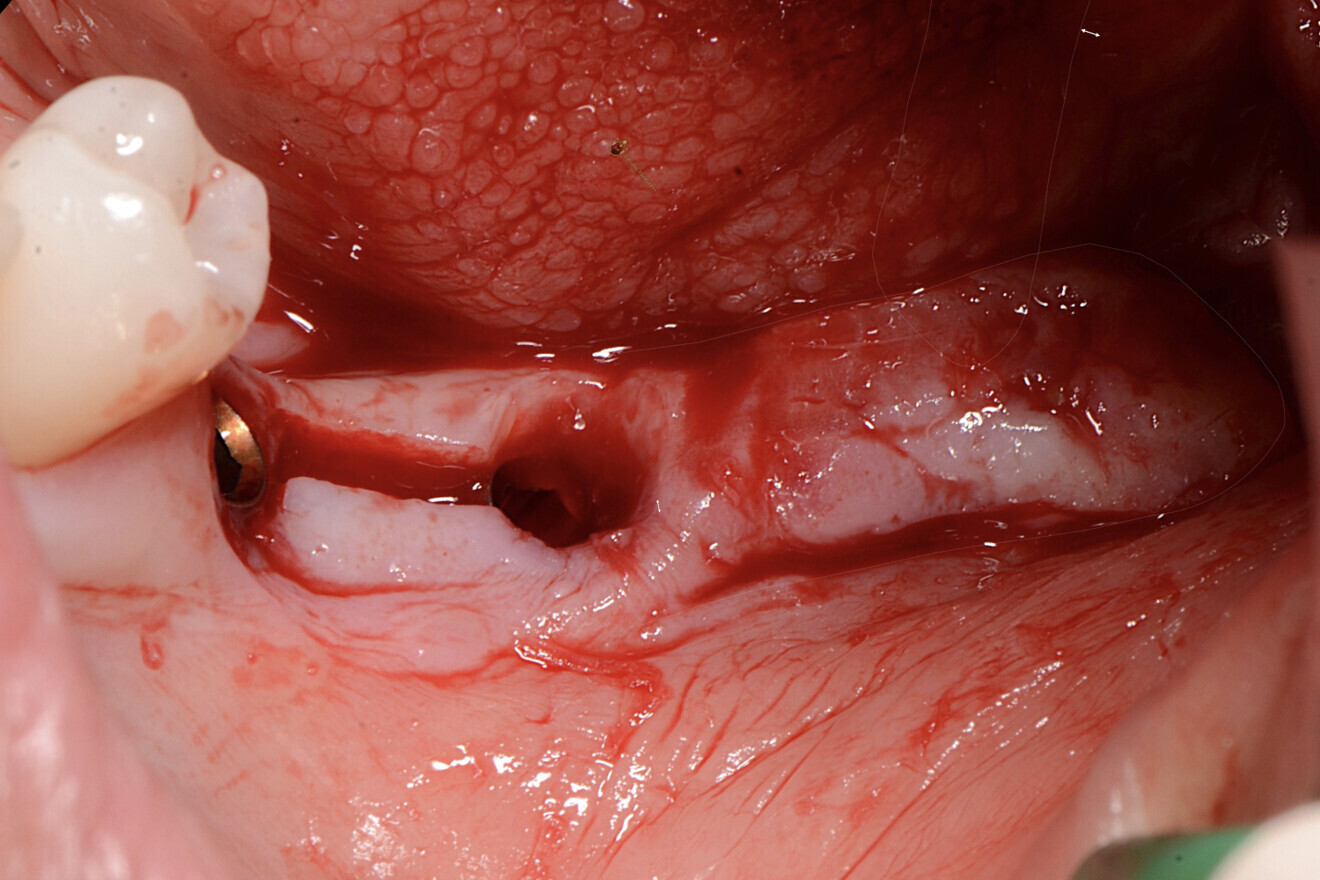 Figs. 6-9 : Lambeau d’épaisseur partielle.