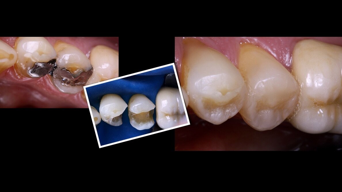 Estética Directa: luz y color en restauraciones de resina compuesta