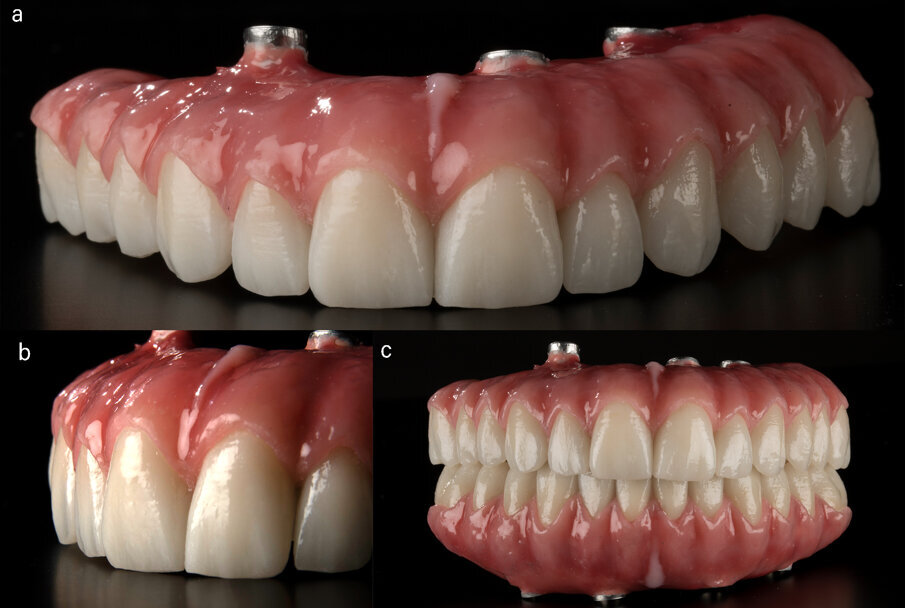 Fig. 8 - Fotografie delle protesi definitive. 8a: protesi superiore. 8b: dettaglio protesi superiore. 8c: protesi superiore e inferiore in masticazione.