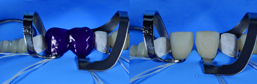 Fig. 16b: Etching of the enamel for 30 seconds with a 32 % orthophosphoric acid.