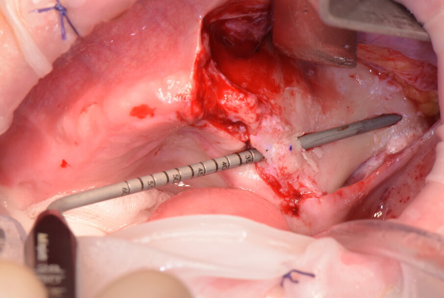 Fig. 5c - Misurazione della lunghezza implantare.
