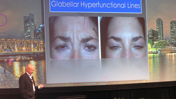 Το Botox μπορεί να βελτιστοποιήσει την αισθητική εμφάνιση των ασθενών με οδοντικά εμφυτεύματα, λέει ο ειδικός