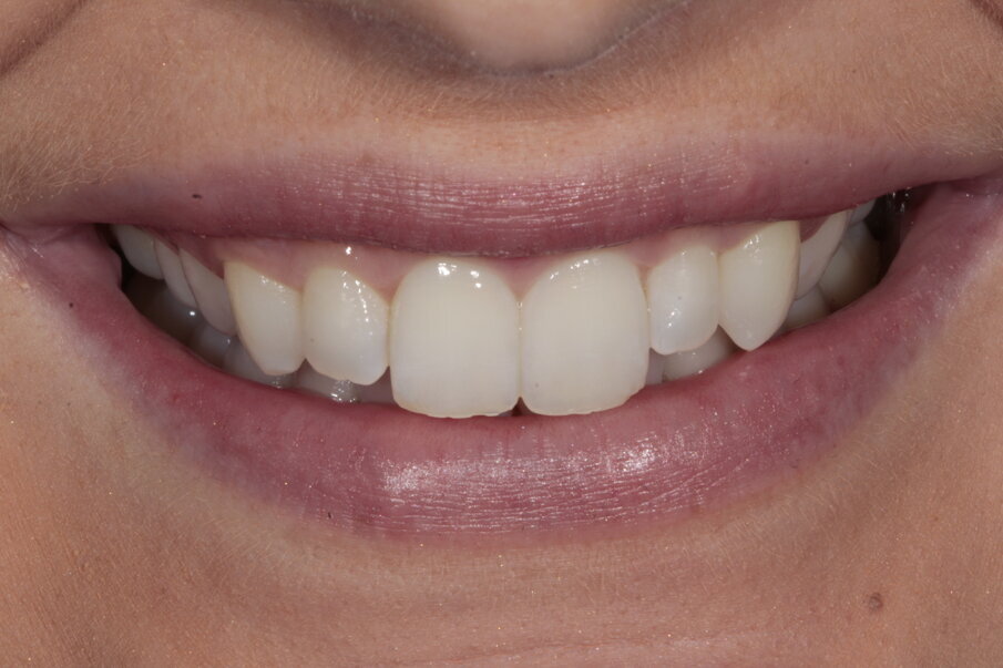 15. Na behandeling met aligner en bleken, vooraanzicht