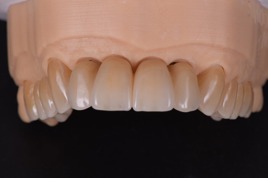 Fig. 45_Il modello digitale rappresenta un mezzo per presentare il restauro nel progetto. È eseguito a computer e solo alcune modifiche vengono fatte, come l’aggiunta di ceramica per enfatizzare l’aspetto estetico. Altro significato è deputato alla precisa posizione degli analoghi implantari.