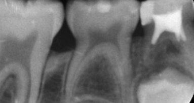 Il trattamento endodontico nel paziente pediatrico