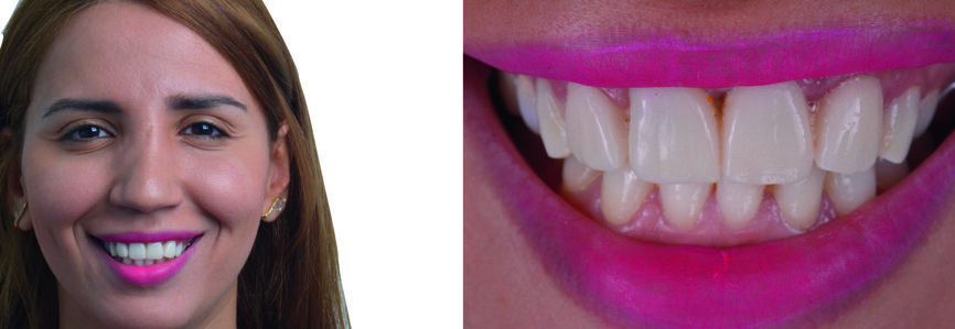 Figs. 21–23 : Restaurations provisoires vissées sur les implants. 