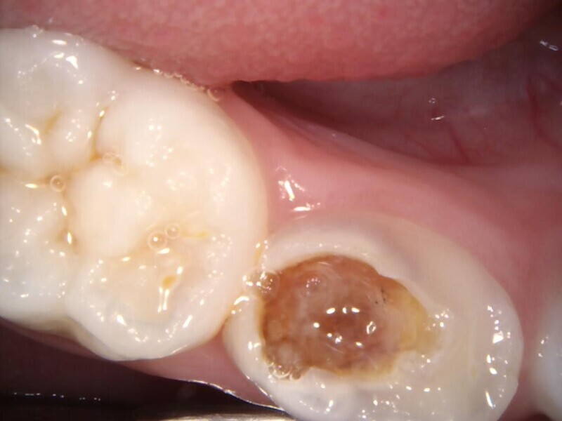 Fig. 14 : Lésion carieuse avancée.