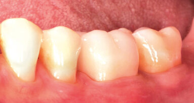 Following a simpler path  from prep to crown